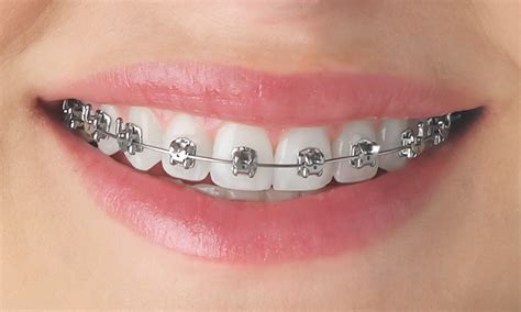 metal bracket zahnspange|metallbrackets dental one.